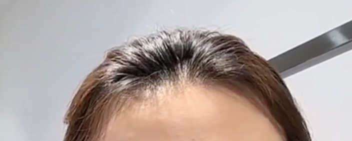 Thin hair, visible scalp